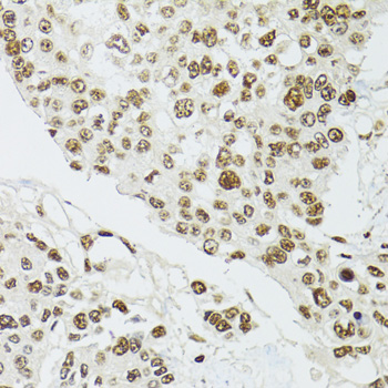 CDX2 Antibody - Immunohistochemistry of paraffin-embedded human prostate cancer using CDX2 antibodyat dilution of 1:100 (40x lens).