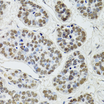 CDX2 Antibody - Immunohistochemistry of paraffin-embedded human esophageal cancer using CDX2 antibodyat dilution of 1:100 (40x lens).