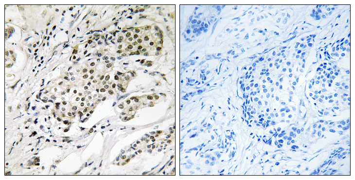 CDYL2 Antibody - Immunohistochemistry analysis of paraffin-embedded human breast carcinoma, using CDYL2 Antibody. The picture on the right is blocked with the synthesized peptide.