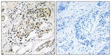 CDYL2 Antibody - Peptide - + Immunohistochemistry analysis of paraffin-embedded human breast carcinoma tissue using CDYL2 antibody.