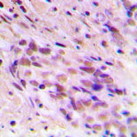CDYL2 Antibody - Immunohistochemical analysis of CDYL2 staining in human breast cancer formalin fixed paraffin embedded tissue section. The section was pre-treated using heat mediated antigen retrieval with sodium citrate buffer (pH 6.0). The section was then incubated with the antibody at room temperature and detected using an HRP conjugated compact polymer system. DAB was used as the chromogen. The section was then counterstained with hematoxylin and mounted with DPX.
