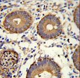 CEA / Carcinoembryonic Antigen Antibody - CEA Antibody immunohistochemistry of formalin-fixed and paraffin-embedded human colon carcinoma followed by peroxidase-conjugated secondary antibody and DAB staining.