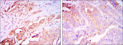 CEA / Carcinoembryonic Antigen Antibody - IHC of paraffin-embedded rectum cancer tissues (left) and stomach cancer tissues (right) using CEA mouse monoclonal antibody with DAB staining.