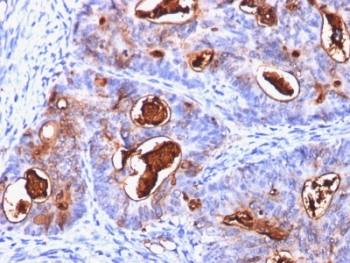 CEA / Carcinoembryonic Antigen Antibody - Formalin-fixed, paraffin-embedded human colon carcinoma stained with CEA antibody (C66/1260).  This image was taken for the unmodified form of this product. Other forms have not been tested.