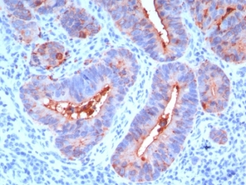 CEA / Carcinoembryonic Antigen Antibody - Formalin-fixed, paraffin-embedded human colon carcinoma stained with CEA antibody (C66/195).  This image was taken for the unmodified form of this product. Other forms have not been tested.