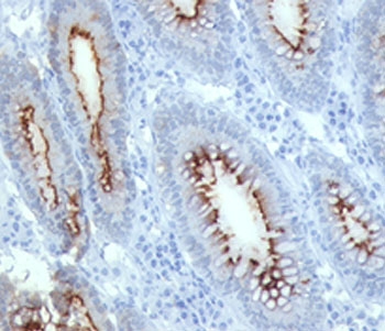 CEA / Carcinoembryonic Antigen Antibody - IHC with CEA antibody C66/261 colon carcinoma.  This image was taken for the unmodified form of this product. Other forms have not been tested.