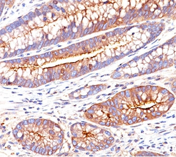 CEA / Carcinoembryonic Antigen Antibody - CEA antibody C66/261 immunohistochemistry1 colon carcinoma.  This image was taken for the unmodified form of this product. Other forms have not been tested.