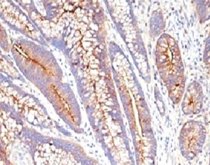 CEA / Carcinoembryonic Antigen Antibody - CEA antibody C66/1009 IHC of human colon carcinoma.  This image was taken for the unmodified form of this product. Other forms have not been tested.