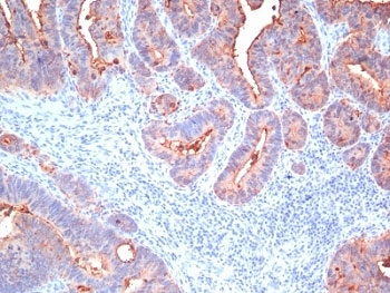 CEA / Carcinoembryonic Antigen Antibody - Formalin-fixed, paraffin-embedded human colon carcinoma stained with pan-CEA antibody (C66/195 + C66/261 + C66/1009 + C66/1030).  This image was taken for the unmodified form of this product. Other forms have not been tested.