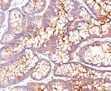 CEA / Carcinoembryonic Antigen Antibody - CEA antibody CEA31 immunohistochemistry.  This image was taken for the unmodified form of this product. Other forms have not been tested.
