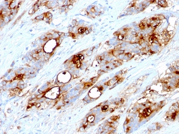 CEA / Carcinoembryonic Antigen Antibody - IHC testing of human colon carcinoma stained with CEA antibody (CEA31).