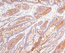 CEA / Carcinoembryonic Antigen Antibody - CEA antibody COL-1 immunohistochemistry.  This image was taken for the unmodified form of this product. Other forms have not been tested.