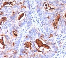CEA / Carcinoembryonic Antigen Antibody - CEA antibody COL-1 + CEA31 + C66/261 immunohistochemistry.  This image was taken for the unmodified form of this product. Other forms have not been tested.