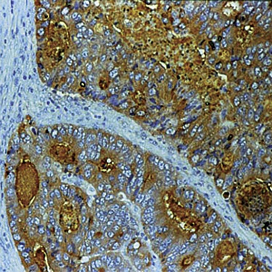 CEA / Carcinoembryonic Antigen Antibody - Formalin-fixed, paraffin-embedded human colon carcinoma stained with CEA antibody.