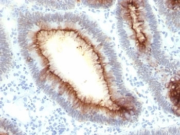 CEA / Carcinoembryonic Antigen Antibody - Formalin-fixed, paraffin-embedded human colon carcinoma stained with CEA antibody (SPM330).  This image was taken for the unmodified form of this product. Other forms have not been tested.