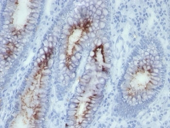 CEA / Carcinoembryonic Antigen Antibody - Formalin-fixed, paraffin-embedded human colon carcinoma stained with anti-CEA antibody (SPM506).  This image was taken for the unmodified form of this product. Other forms have not been tested.