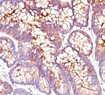 CEA / Carcinoembryonic Antigen Antibody - Formalin-fixed, paraffin-embedded human colon carcinoma stained with CEA antibody (SPM541).  This image was taken for the unmodified form of this product. Other forms have not been tested.