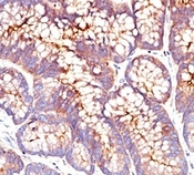 CEA / Carcinoembryonic Antigen Antibody - Formalin-fixed, paraffin-embedded human colon carcinoma stained with CEA antibody (SPM541).  This image was taken for the unmodified form of this product. Other forms have not been tested.