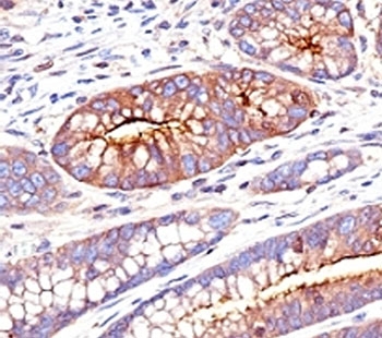 CEA / Carcinoembryonic Antigen Antibody - Formalin-fixed, paraffin-embedded human colon carcinoma stained with CEA antibody (SPM551).  This image was taken for the unmodified form of this product. Other forms have not been tested.