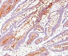 CEA / Carcinoembryonic Antigen Antibody - Formalin-fixed, paraffin-embedded human colon carcinoma stained with CEA antibody (SPM584).  This image was taken for the unmodified form of this product. Other forms have not been tested.