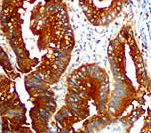 CEA / Carcinoembryonic Antigen Antibody - IHC of CEA on FFPE Colon Adenocarcinoma tissue. This image was taken for the unmodified form of this product. Other forms have not been tested.