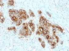 CEACAM1,5 Antibody - Formalin-fixed, paraffin-embedded human Colon Carcinoma stained with CEA Rabbit Recombinant Monoclonal Antibody (C66/2055R).