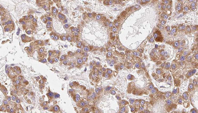 CEACAM20 Antibody - 1:100 staining human liver carcinoma tissues by IHC-P. The sample was formaldehyde fixed and a heat mediated antigen retrieval step in citrate buffer was performed. The sample was then blocked and incubated with the antibody for 1.5 hours at 22°C. An HRP conjugated goat anti-rabbit antibody was used as the secondary.