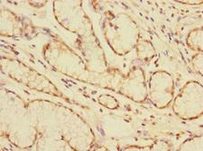 CEACAM4 Antibody - Immunohistochemistry of paraffin-embedded human colon cancer at dilution 1:100
