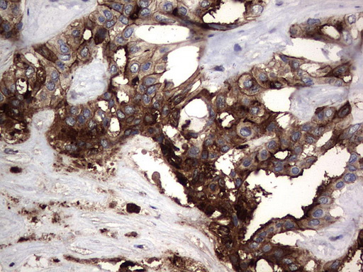CEACAM5 / CD66e Antibody - IHC of paraffin-embedded Carcinoma of Human liver tissue using anti-CEACAM5 mouse monoclonal antibody. (Heat-induced epitope retrieval by 1 mM EDTA in 10mM Tris, pH9.0, 120°C for 3min).