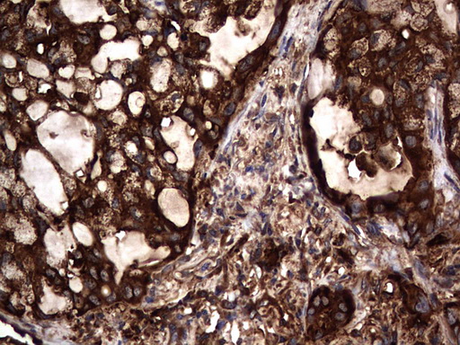 CEACAM5 / CD66e Antibody - IHC of paraffin-embedded Carcinoma of Human lung tissue using anti-CEACAM5 mouse monoclonal antibody. (Heat-induced epitope retrieval by 1 mM EDTA in 10mM Tris, pH9.0, 120°C for 3min).