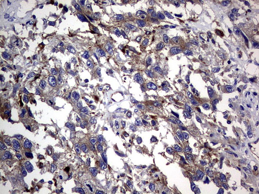 CEACAM5 / CD66e Antibody - IHC of paraffin-embedded Adenocarcinoma of Human ovary tissue using anti-CEACAM5 mouse monoclonal antibody. (Heat-induced epitope retrieval by 1 mM EDTA in 10mM Tris, pH9.0, 120°C for 3min).