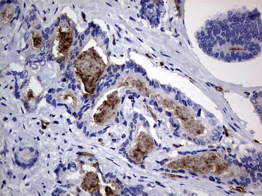 CEACAM5 / CD66e Antibody - IHC of paraffin-embedded Human prostate tissue using anti-CEACAM5 mouse monoclonal antibody. (Heat-induced epitope retrieval by 1 mM EDTA in 10mM Tris, pH9.0, 120°C for 3min).