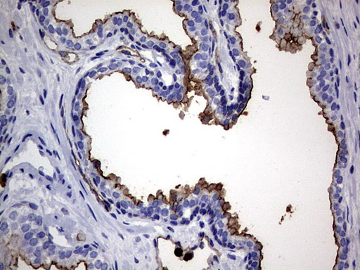 CEACAM5 / CD66e Antibody - IHC of paraffin-embedded Carcinoma of Human prostate tissue using anti-CEACAM5 mouse monoclonal antibody. (Heat-induced epitope retrieval by 1 mM EDTA in 10mM Tris, pH9.0, 120°C for 3min).