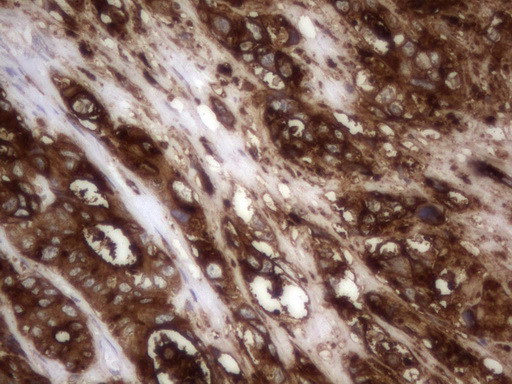 CEACAM5 / CD66e Antibody - IHC of paraffin-embedded Adenocarcinoma of Human colon tissue using anti-CEACAM5 mouse monoclonal antibody. (Heat-induced epitope retrieval by 1 mM EDTA in 10mM Tris, pH8.5, 120°C for 3min).