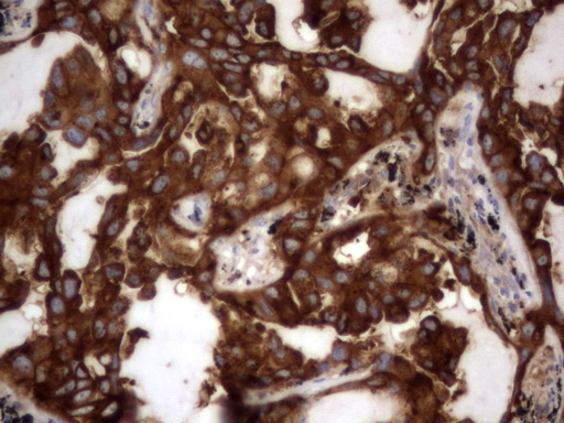 CEACAM5 / CD66e Antibody - IHC of paraffin-embedded Carcinoma of Human lung tissue using anti-CEACAM5 mouse monoclonal antibody. (Heat-induced epitope retrieval by 1 mM EDTA in 10mM Tris, pH8.5, 120°C for 3min).