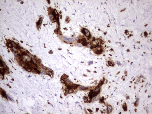 CEACAM5 / CD66e Antibody - IHC of paraffin-embedded Carcinoma of Human pancreas tissue using anti-CEACAM5 mouse monoclonal antibody. (Heat-induced epitope retrieval by 1 mM EDTA in 10mM Tris, pH8.5, 120°C for 3min).