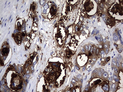 CEACAM5 / CD66e Antibody - IHC of paraffin-embedded Adenocarcinoma of Human colon tissue using anti-CEACAM5 mouse monoclonal antibody. (Heat-induced epitope retrieval by 1 mM EDTA in 10mM Tris, pH9.0, 120°C for 3min).