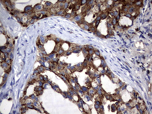 CEACAM5 / CD66e Antibody - IHC of paraffin-embedded Carcinoma of Human lung tissue using anti-CEACAM5 mouse monoclonal antibody. (Heat-induced epitope retrieval by 1 mM EDTA in 10mM Tris, pH9.0, 120°C for 3min).