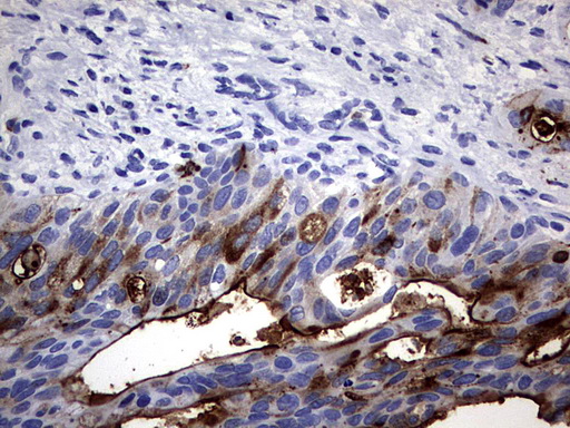 CEACAM5 / CD66e Antibody - IHC of paraffin-embedded Carcinoma of Human pancreas tissue using anti-CEACAM5 mouse monoclonal antibody. (Heat-induced epitope retrieval by 1 mM EDTA in 10mM Tris, pH9.0, 120°C for 3min).
