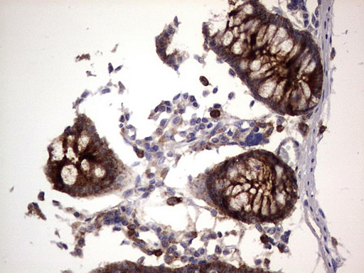 CEACAM5 / CD66e Antibody - IHC of paraffin-embedded Human colon tissue using anti-CEACAM5 mouse monoclonal antibody. (heat-induced epitope retrieval by 1 mM EDTA in 10mM Tris, pH8.5, 120°C for 3min).
