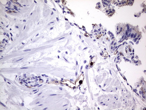 CEACAM5 / CD66e Antibody - IHC of paraffin-embedded Carcinoma of Human prostate tissue using anti-CEACAM5 mouse monoclonal antibody. (heat-induced epitope retrieval by 1 mM EDTA in 10mM Tris, pH8.5, 120°C for 3min).