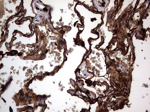 CEACAM5 / CD66e Antibody - IHC of paraffin-embedded Human lung tissue using anti-CEACAM5 mouse monoclonal antibody. (heat-induced epitope retrieval by 1 mM EDTA in 10mM Tris, pH8.5, 120°C for 3min).