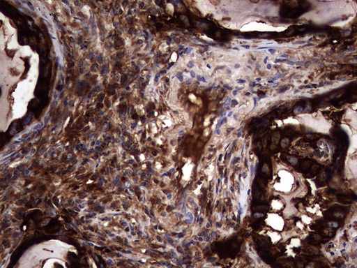 CEACAM5 / CD66e Antibody - IHC of paraffin-embedded Carcinoma of Human lung tissue using anti-CEACAM5 mouse monoclonal antibody. (heat-induced epitope retrieval by 1 mM EDTA in 10mM Tris, pH8.5, 120°C for 3min).