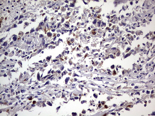 CEACAM5 / CD66e Antibody - IHC of paraffin-embedded Adenocarcinoma of Human ovary tissue using anti-CEACAM5 mouse monoclonal antibody. (heat-induced epitope retrieval by 1 mM EDTA in 10mM Tris, pH8.5, 120°C for 3min).