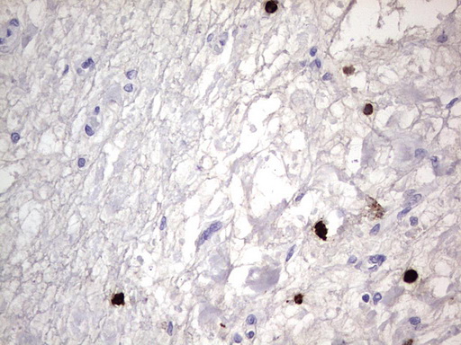 CEACAM5 / CD66e Antibody - IHC of paraffin-embedded Human bladder tissue using anti-CEACAM5 mouse monoclonal antibody. (heat-induced epitope retrieval by 1 mM EDTA in 10mM Tris, pH8.5, 120°C for 3min).