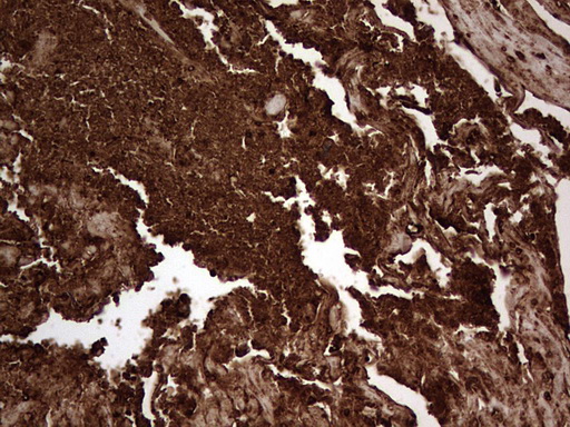 CEACAM5 / CD66e Antibody - IHC of paraffin-embedded Carcinoma of Human bladder tissue using anti-CEACAM5 mouse monoclonal antibody. (heat-induced epitope retrieval by 1 mM EDTA in 10mM Tris, pH8.5, 120°C for 3min).