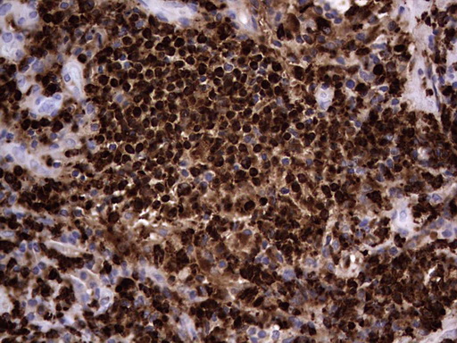 CEACAM5 / CD66e Antibody - IHC of paraffin-embedded Human lymph node tissue using anti-CEACAM5 mouse monoclonal antibody. (heat-induced epitope retrieval by 1 mM EDTA in 10mM Tris, pH8.5, 120°C for 3min).