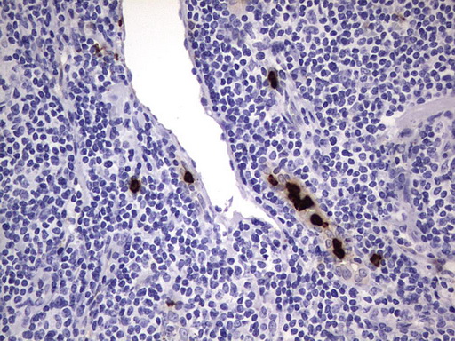 CEACAM5 / CD66e Antibody - IHC of paraffin-embedded Human lymphoma tissue using anti-CEACAM5 mouse monoclonal antibody. (heat-induced epitope retrieval by 1 mM EDTA in 10mM Tris, pH8.5, 120°C for 3min).
