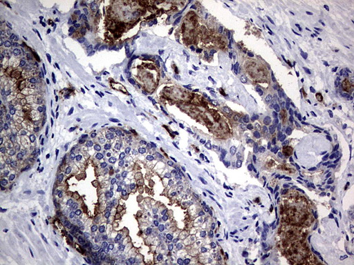 CEACAM5 / CD66e Antibody - IHC of paraffin-embedded Human prostate tissue using anti-CEACAM5 mouse monoclonal antibody. (Heat-induced epitope retrieval by 1 mM EDTA in 10mM Tris, pH9.0, 120°C for 3min).