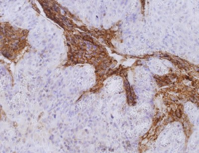 CEACAM5 / CD66e Antibody - Immunohistochemistry staining of colorectal carcinoma (paraffin-embedded sections) with anti-human CD66e (CB30).  Primary antibody dilution: 10 µg/ml.